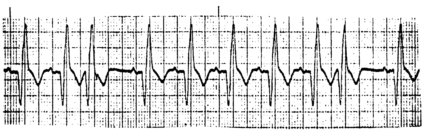 <p>What ECG is this? </p>
