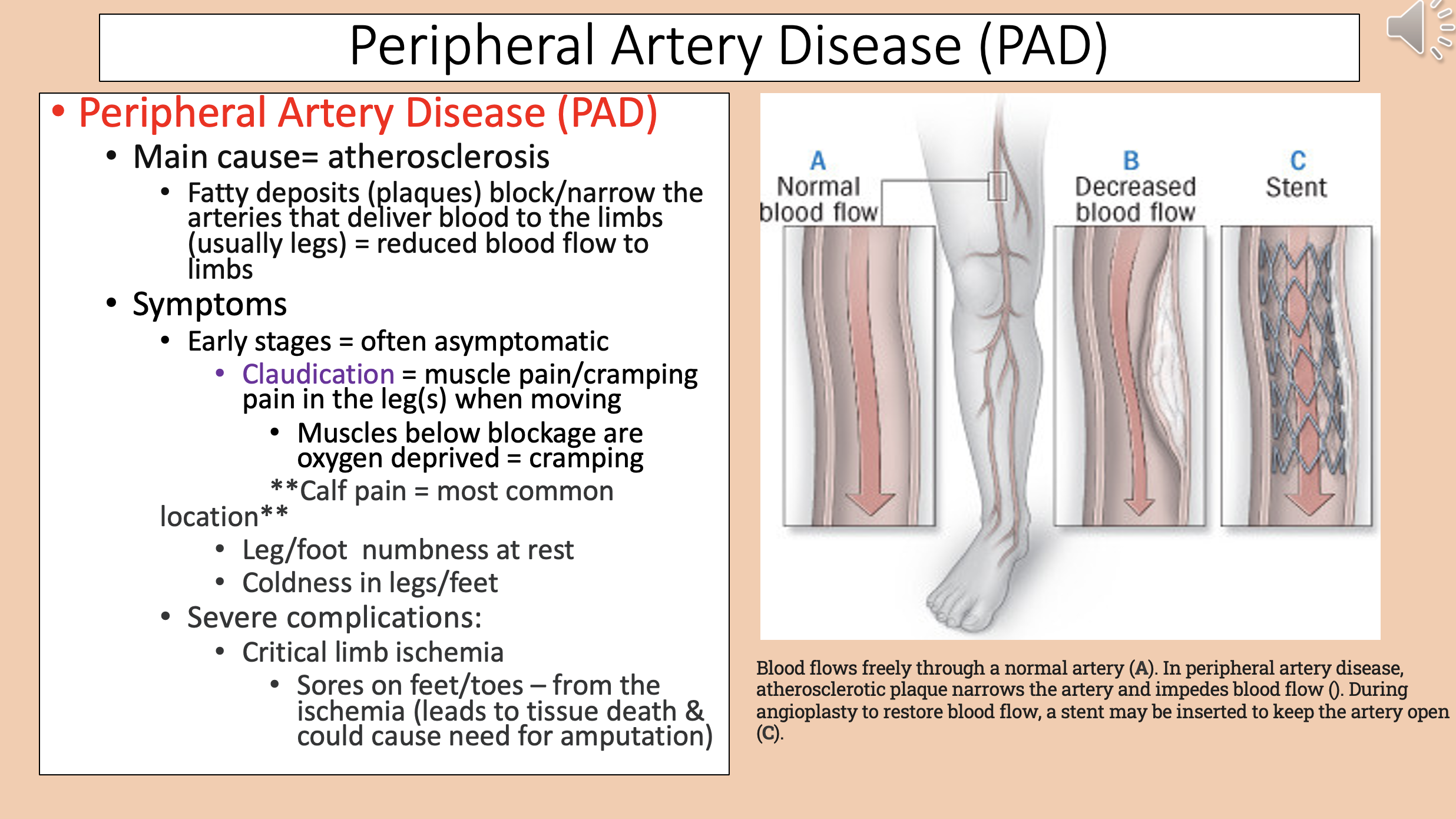 <p><span style="color: rgb(52, 53, 54);">critical limb ischemia</span></p>