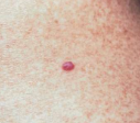 <p>Cherry Angioma</p>