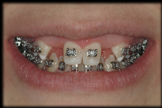 <p>gingival display at smile </p>