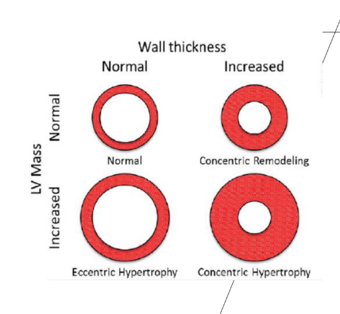 <p>Eccentric Hypertrophy</p>