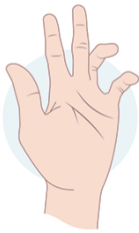 <p>What condition is this called and what nerve is affected?</p>