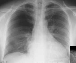 <p>the included image has an example of a thoracic abnormality; what is it?</p>