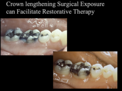 <p>- Surgical Exposure to facilitate restorative therapy</p><p>- To improve esthetics</p>