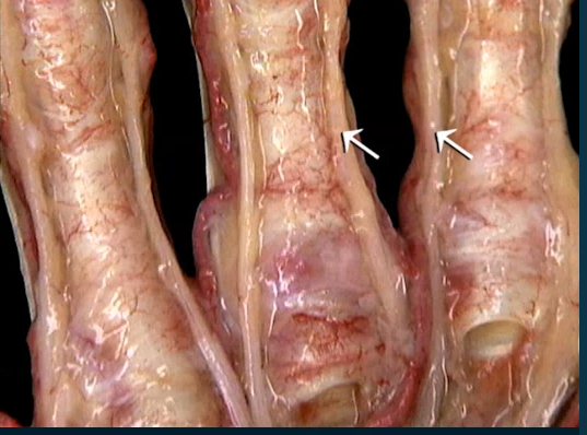 <p>Oppervlakkig, Vinger, Anterior</p>