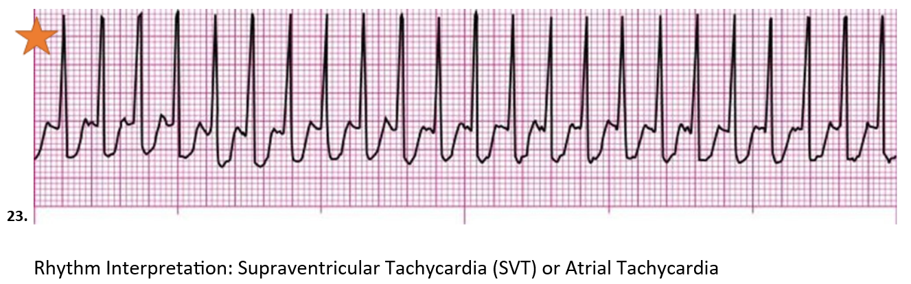 <p>Supraventricular Tachycardia (SVT) or Atrial Tachycardia</p>