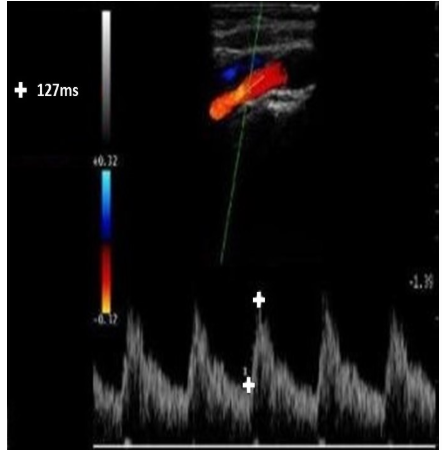 <p>What blood flow characteristics is being measured on the Doppler tracings provided?</p>