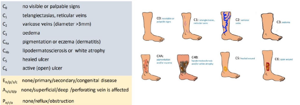 <ul><li><p>CEAP classification</p></li><li><p>C-clinical</p></li><li><p>E-etiological</p></li><li><p>A-anatomical</p></li><li><p>P-pathophysiological</p></li></ul><p></p>