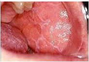 <p>What is Lichen Planus? </p>