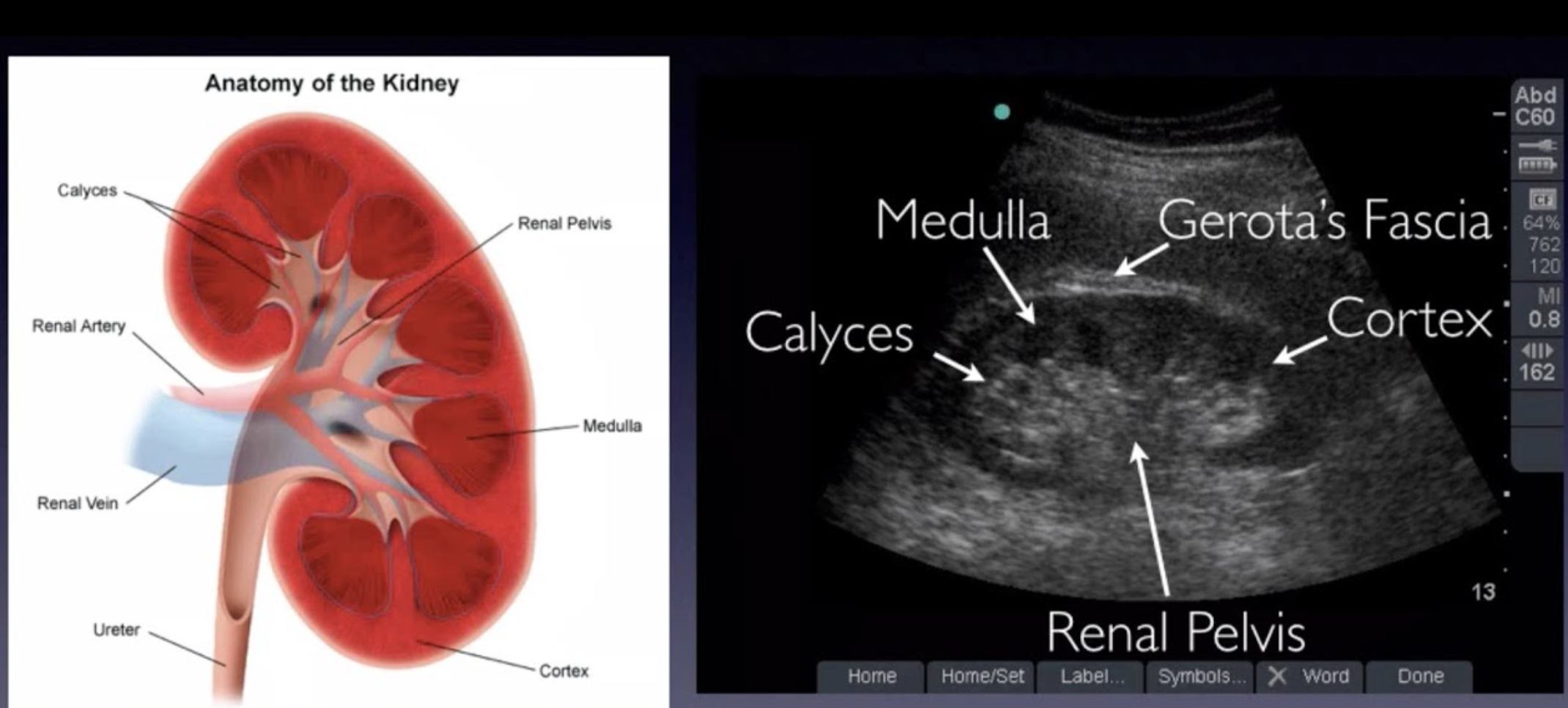 <p>medullary nephrocalcinosis</p><p>cortical nephrocalcinosis</p>