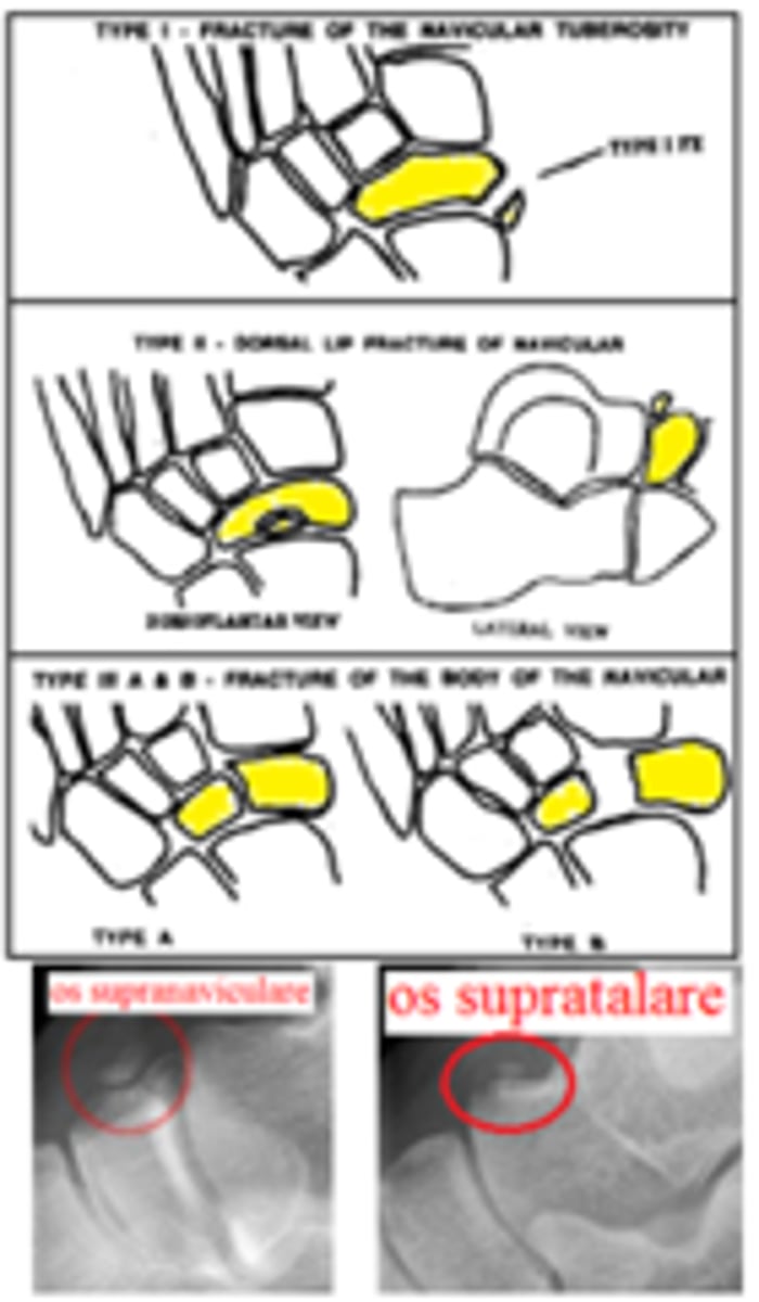 <p>Navicular Fractures</p><p>Type 1 - navicular tuberosity fracture</p><p>Type 2 - dorsal lip fracture</p><p>Type 3 - transverse body fracture</p><p>3A - fracture of body without displacement</p><p>3B - fracture of body with displacement</p><p>Type 4 - stress fracture</p>