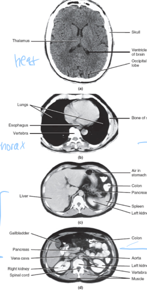 <p>computed tomography</p><p>patient doesnt move, CT scanners rotate 360 degrees</p><p>xray rotates around very fast</p><p>a lot more radiation than xrays, dont want these often</p><p>a lot more detail of internal</p><p>usually get axial/horizontal sections and computers can change into diff planes</p>