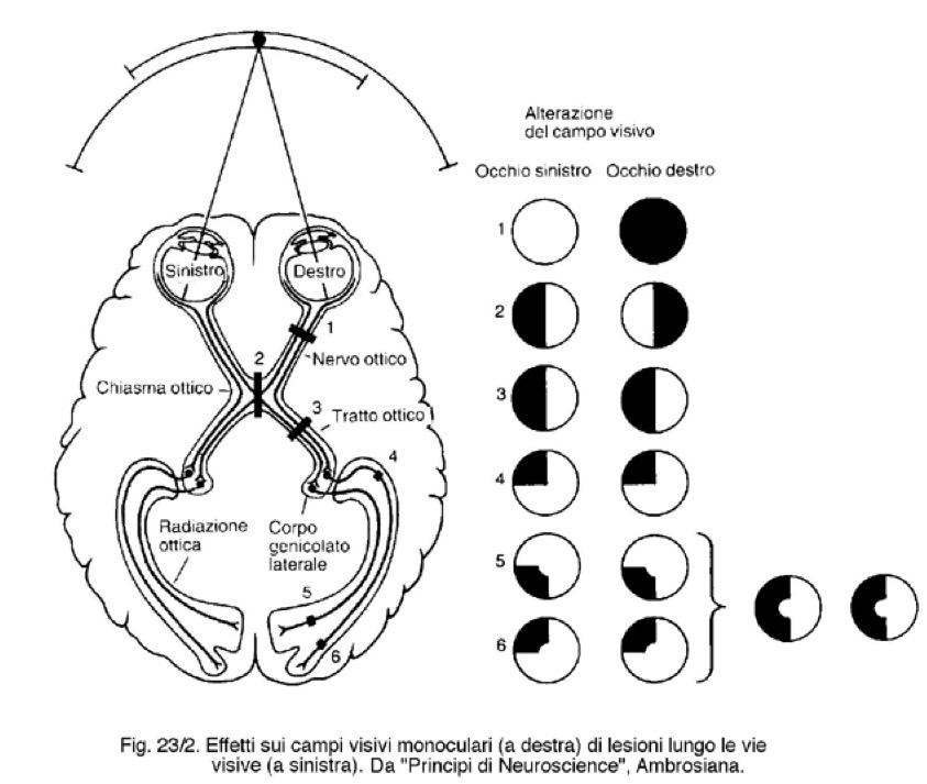 <p><strong><span>Manovre neurologiche per gli occhi</span></strong></p><p><span>1. </span><strong><span>Reazione alla luce:</span></strong><span> separare con la mano i due occhi e poi illuminare e vedere se si genera la miosi sia nell'occhio illuminato (diretta) sia nel controlaterale (consensuale).</span></p><p><span>2. </span><strong><span>Avvicinamento/Divergenza:</span></strong><span> Seguendo il dito verso il naso si ha convergenza, miosi e accomodazione del cristallino (messa a fuoco).</span></p><p><span>3. </span><strong><span>Motilità muscoli estrinseci:</span></strong><span> Seguendo il dito in 6 direzioni si evidenziano paralisi, strabismo paralitico (provocato da paralisi muscoli extraoculari, deviazione che dipende dallo sguardo) o non paralitico/concomitante (squilibrio del tono della muscolatura, deviazione costante), esotropia (strabismo convergente) ed exotropia (divergente) e nistagmi (oscillazione ritmica per patologie cervelletto).</span></p><p><span>4. </span><strong><span>Campimetria manuale:</span></strong><span> Test di confronto faccia a faccia per scovare alterazioni del campo visivo (es. cecità monolaterale, emianopsia bitemporale da lesione del chiasma, emianopsia/quadrantanopsia omonima). Manovra in 8 direzioni dove l’esaminatore stende il braccio e avvicina l’oggetto lungo un piano, si segnala quando si vede l’oggetto (le alterazioni possono essere orizzontali o verticali).</span></p>