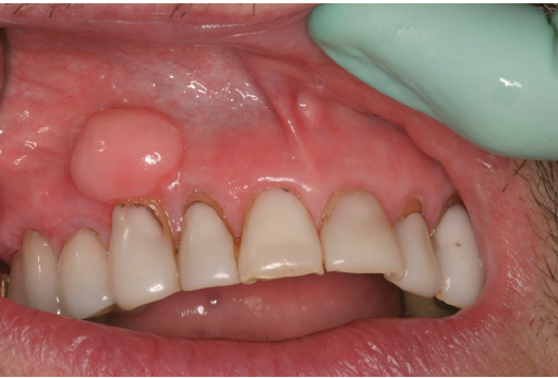 <p>post surgical hyperostosis</p>