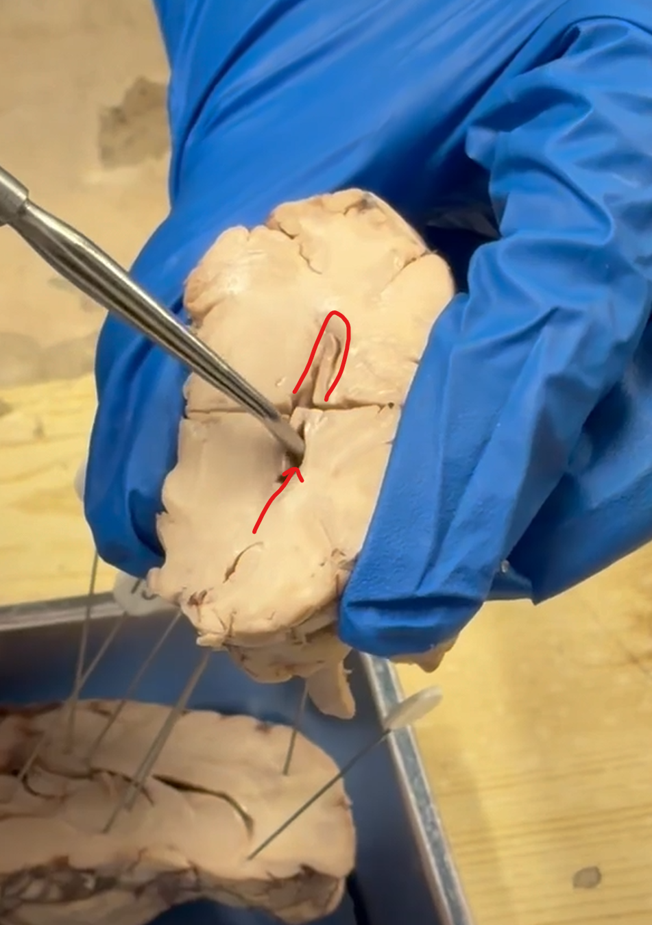 <p>Coronal Cut (Posterior): Structure?</p>
