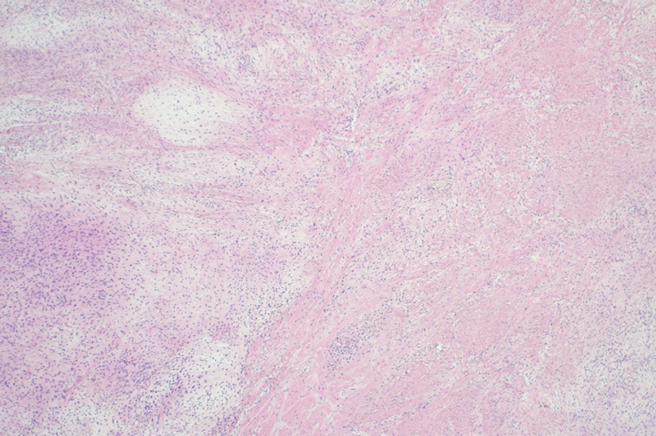 <p>tumeur des tissus mous du bras d’un jeune homme </p><p>1) Diagnostic</p><p>2) localisation, âge, pronostique</p><p>3) Histo</p><p>4) IHC</p><p>5) Moléculaire</p>