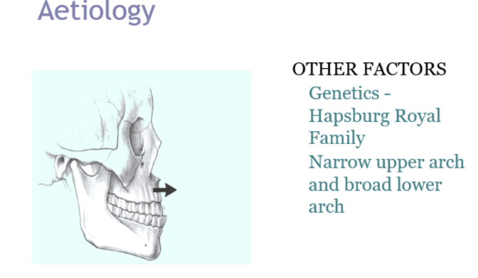 <ul><li><p>Genetics</p></li><li><p>Craniofacial anomalies - cleft lip and palate, binders syndrome</p></li><li><p>Habits do not play a role</p></li></ul><p></p>