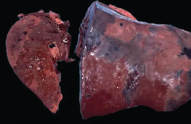 <ul><li><p>Liver is swollen, gray-brown, yellow areas of necrosis surrounded by bright red hyperemia</p></li><li><p>Engorgement of SC vessels and edema</p></li><li><p>Dark appears of inside the skin → “black disease”</p></li></ul><p></p>