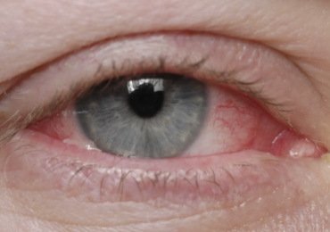<p>Infection of the <u>conjunctiva</u></p><ul><li><p>Transmission: Eye secretions</p></li><li><p>Diagnosis: Clear discharge</p></li><li><p>Prevention: Hygiene</p></li><li><p>Treatment: None</p></li><li><p>Epidemiology: Very transmissible</p></li></ul><p></p>