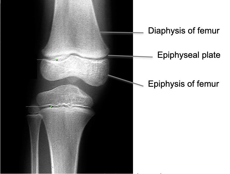 <p>Proliferation rate slows near end of adolescence… cartilaginous tissue overtaken by ossification… epiphyseal plate ossifies entirely = fusion/closure which is the end of longitudinal growth</p>