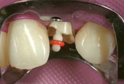 <p>What is a Fiber Post?</p>