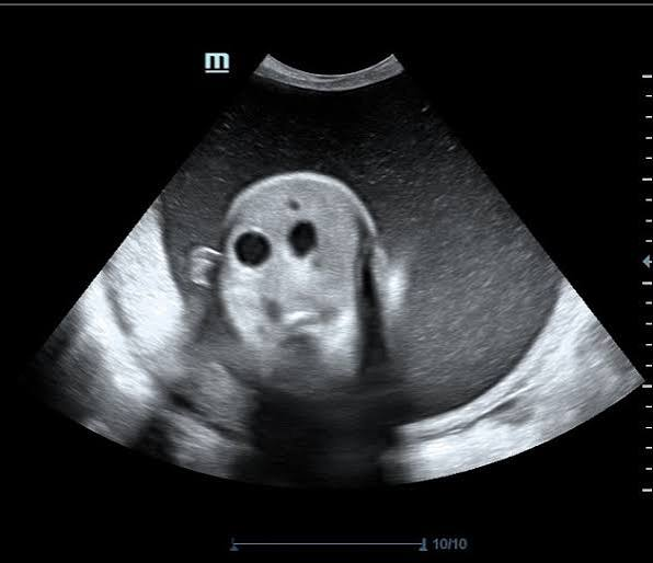<p>associated with trisomy 21</p><ul><li><p>blockage of duodenum </p></li><li><p>dilated stomach and duodenum </p><ul><li><p>double bubble sign</p></li></ul></li><li><p>polyhydraminos </p></li></ul><p></p>