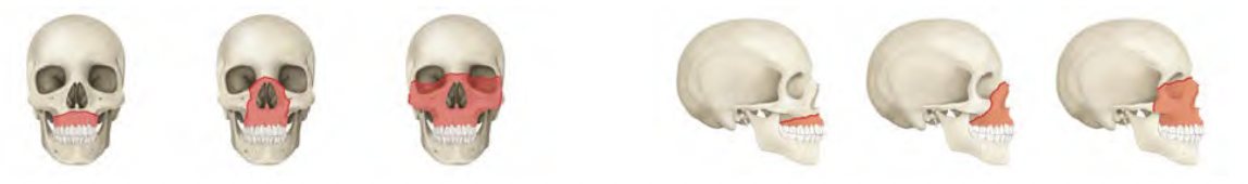 <p>A Le Fort II fracture involves the midface, specifically the nasal bones, maxilla, and zygomatic arch, resulting in separation from the cranial base. </p>