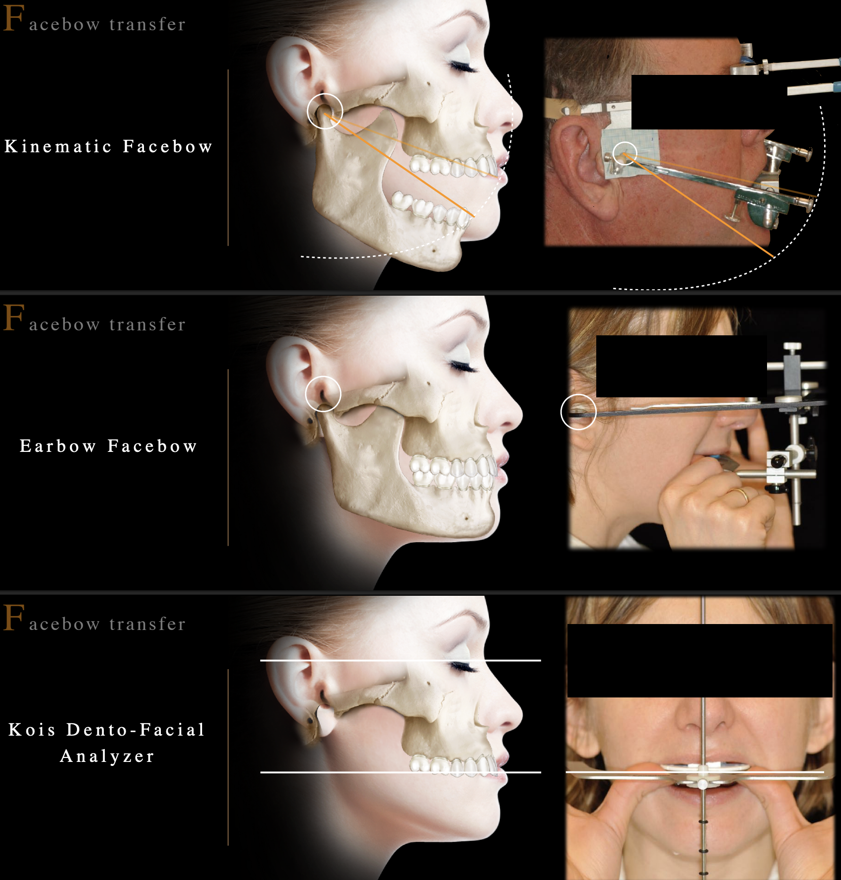 <ul><li><p>kinematic facebow </p></li><li><p>earbow facebow </p></li><li><p>Kois Dento-facial Analyser </p></li></ul><p></p>