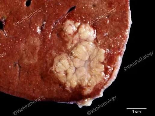 <p>Hyperplasia </p>