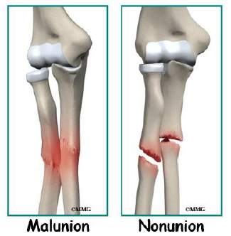 <p>Imperfect fracture heal - non-unions. </p><p>May be associated with limb length discrepancy, infection and stiff joints</p><p>Fractures can heal in incorrect position with shortening, angular deviation or rotation. Malunion</p><p>If bone fragment does not ‘glue’ back, small fragment can turn into sequestrum, acts as foreign body</p>