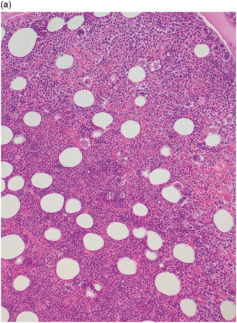 <p>MYELOID HYPERPLASIA</p>