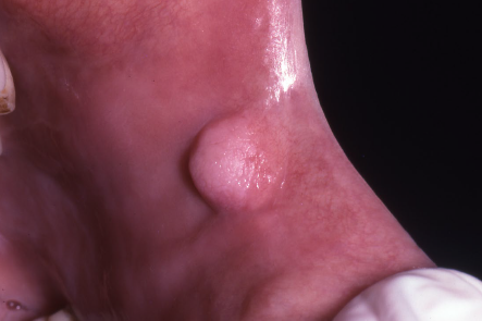 <ul><li><p>most common “tumor” of the oral cavity</p></li><li><p>not a true neoplasm- inflammatory/ reactive tumor</p></li><li><p>reactive lesion, secondary to trauma or chronic irritation </p></li><li><p>buccal mucosa as the most common location</p></li><li><p>labial mucosa, tongue, and gingiva</p></li><li><p>conservative surgical excision as the treatment, recurrence is rare </p></li></ul><p></p>