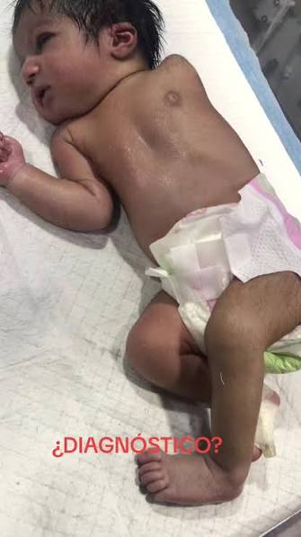 <p>Malformación congénita poco frecuente en la que el bebé nace con la ausencia total de una o más extremidades</p>