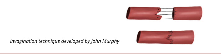 <p>invagination technique: placing part of one vessel inside of another </p><ul><li><p>femoral artery damaged by a gunshot wound </p></li></ul><p></p>