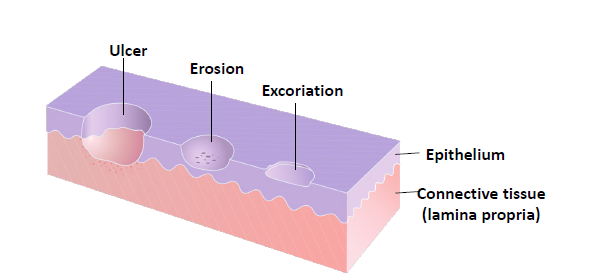 <p>loss of epithelium and underlying connective tissue </p>