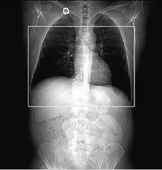 <p>Start location: 2 cm above aortic arch End location: 2 cm below celiac artery</p>