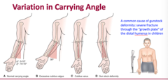 <p>A. normal carrying angle (Female has a larger carrying angle 10-15 degrees and males 5-10 degrees)</p><p>B. excessive cubitus valgus 30 degrees</p><p>C. cubitus varus -5 degrees</p><p>D. gun stock deformity -15 degrees</p><p>A common cause of gunstock deformity: severe fracture through the "growth plate" of the distal humerus in children</p>