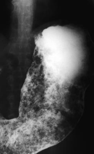 <p>A mass of undigested material that becomes trapped in the stomach.</p>