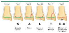 <p>SALTER</p><p>S traight across (type I)</p><p>A bove (type II) </p><p>L ower (type III)</p><p>T two/through (type IV)</p><p>ER asure of growth plate (type V) </p><p>***A and L only work if looking at a distal physis; will need switched if looking at a proximal physis</p>