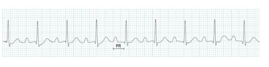 <p>What kind of heart block is this?</p>