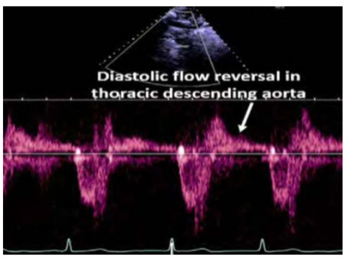 <p>PHT <200 msec or holodiastolic flow reversal in the abdominal aorta suggests</p><p>the presence of severe regurgitation greater than 15</p>