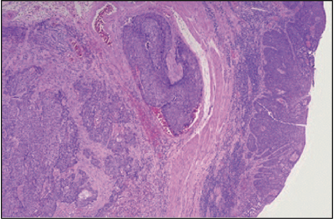 <p>diagnosis, esophageal tumor</p>