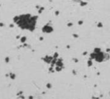 <p>Brown, granules in clumps</p><p>Abnormal, seen post-hemolytic event</p>