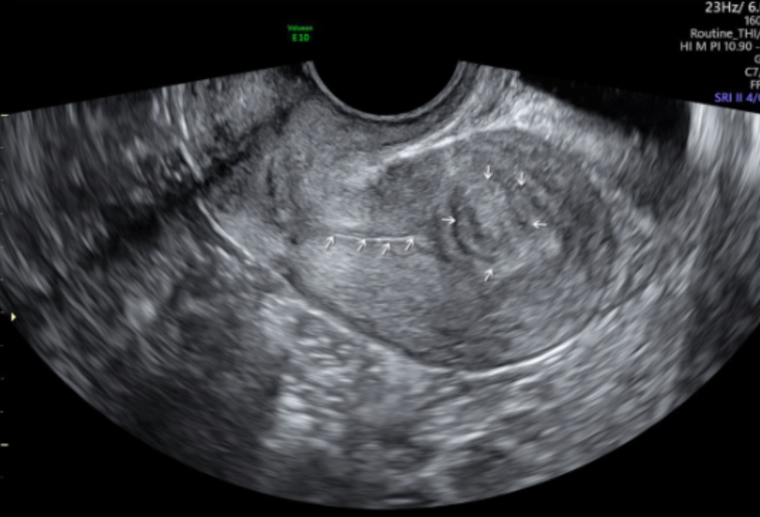 <p>Name the type of fibroid and its location</p>
