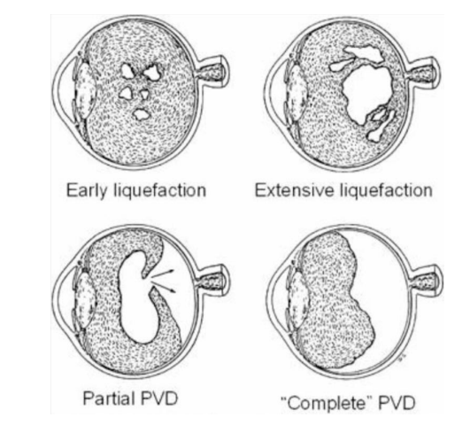 <ul><li><p>Detachment of the vitreous from the retina</p></li><li><p>Occurs in over 60% over 80 years old</p></li><li><p>Flashes and floaters (Photopsia)</p></li><li><p>Not painful</p></li><li><p>PVD leads to complications in 27% of pts</p></li></ul><p></p>