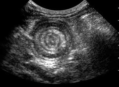 <p>Ultrasound finding of intussusception</p>