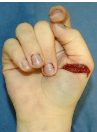 <p><strong>Blade injuries:</strong> wounds caused by <strong>sharp-edged instruments</strong> producing <strong>clean cuts</strong>.</p><p class="isSelectedEnd"><strong>Key features:</strong></p><ul><li><p><strong>Penetrative force</strong> depends on blade <strong>sharpness, cutting edge, pointedness, and length</strong>.</p></li><li><p><strong>Clean, well-defined cuts</strong> usually produced by blades.</p></li><li><p><strong>Movement during infliction</strong> (e.g., victim defending themselves) may cause <strong>irregular wounds</strong>.</p></li><li><p><strong>Bladed weapons are easily accessible</strong> (e.g., knives, razor blades, shivs – handmade weapons). - commonly used and seen </p></li><li><p><strong>Weapon pattern may appear on the skin</strong>, e.g., <strong>serrated knife leaves patterned edges</strong>.</p></li></ul><p></p>