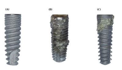 <p>Corrosion is an electrochemical process involving electron transfer through oxidation and reduction reactions. <strong>Oxidation generates electrons at the anode (AN OX = loss of electrons at the anode [aka metal atoms are oxidized at the anode [releasing electrons]) (OR: an OX LOSES [in a battle])</strong>, while <strong>reduction consumes them</strong> at the cathode (FAT RED CAT = reduction is where gains [or CONSUMES] electrons at the cathode). For a metal <em>M</em> with <em>n</em> valence electrons, <strong>oxidation </strong>is represented as M → M^n+ + <strong>ne</strong> (will lose or release electrons). </p><p>Metals are generally more susceptible to degradation than ceramics in physiological fluids due to their electrochemical nature. Think: Ceramics like alumina or zirconia are ionic or covalent solids; they are ALREADY IN A CHEMICALLY STABLE, oxidized state, they do not easily exchange electrons, so in physiological fluids, they don’t form electrochemical cells easily, and they do NOT easily exchange electrons. Corrosion involves ion leaching, potentially causing biological consequences. Characterization is vital for predicting structural changes, failure, and biocompatibility.</p><p>Half-Cell Potentials: <strong>Standard reduction potentials rank metal oxidation behavior relative to a STANDARD HYDROGEN ELECTRODE</strong>. Metals <strong>with more negative potentials are more active (ANODIC)</strong>. The galvanic series (galvanic series rank metals based on their corrosion behavior in environments like seawater; important in real-world conditions like physiological fluids in the body) (when two metals are connected, the more active metal [anode] corrodes and the less active metal [cathode is protected] => this is called galvanic corrosion] <strong>derived from metal corrosion in seawater</strong>, indicates relative activity in saline solutions, similar to bodily fluids.</p>