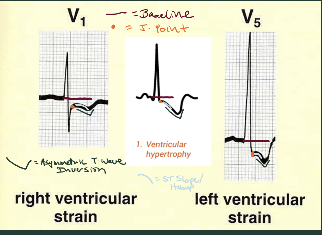 <p>asymmetric T wave inversion, J point below baseline, ST descending slope / humped. </p>