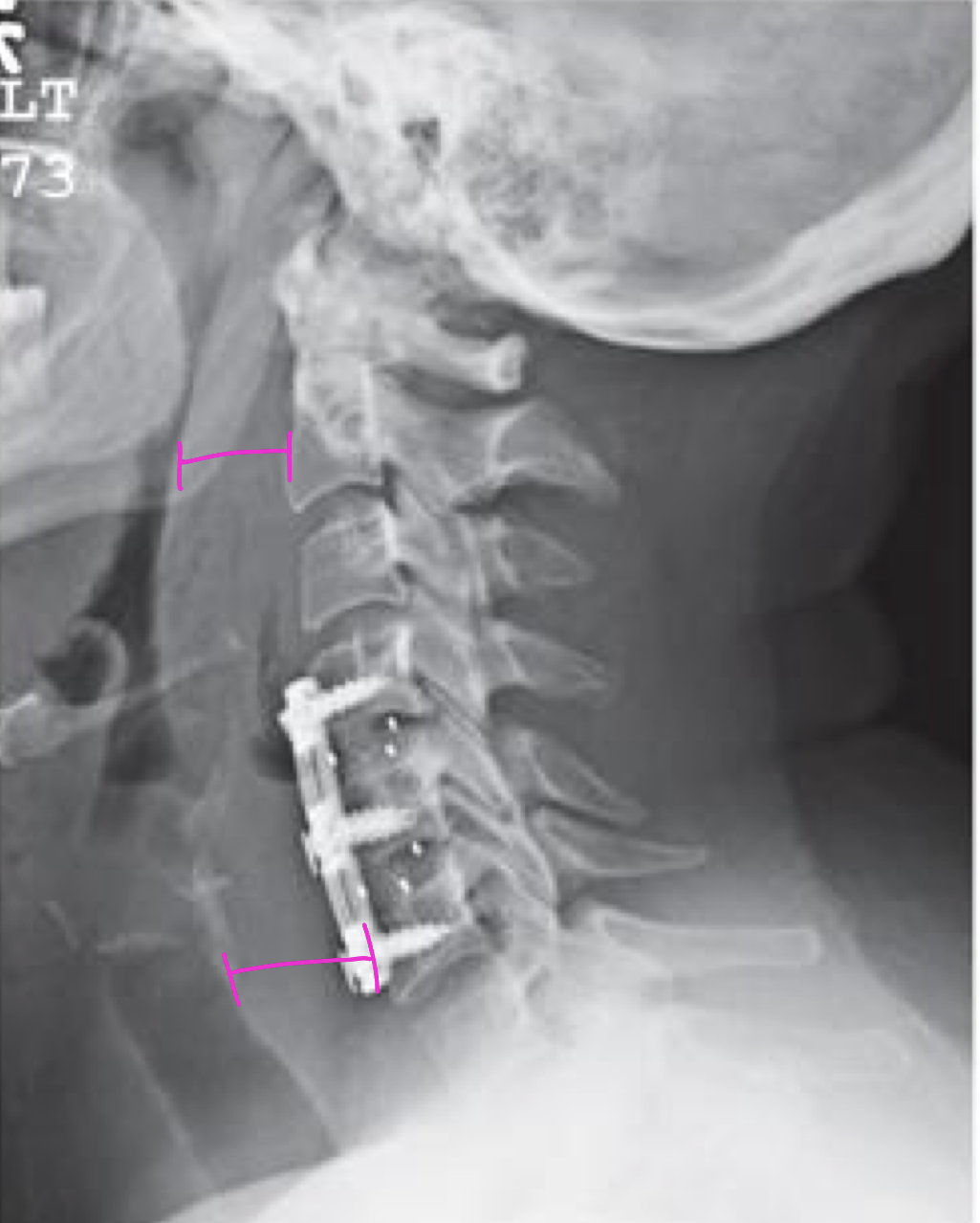 <p>What is causing this 41yo post operative pt’s increased RPI and RTI</p>